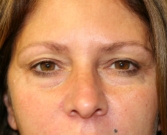 Feel Beautiful - Eyelid Surgery San Diego Case 37 - Before Photo